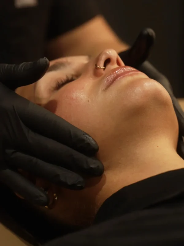 Chemical Peels